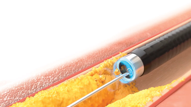 AURYON – Periphere Laser-Atherektomie