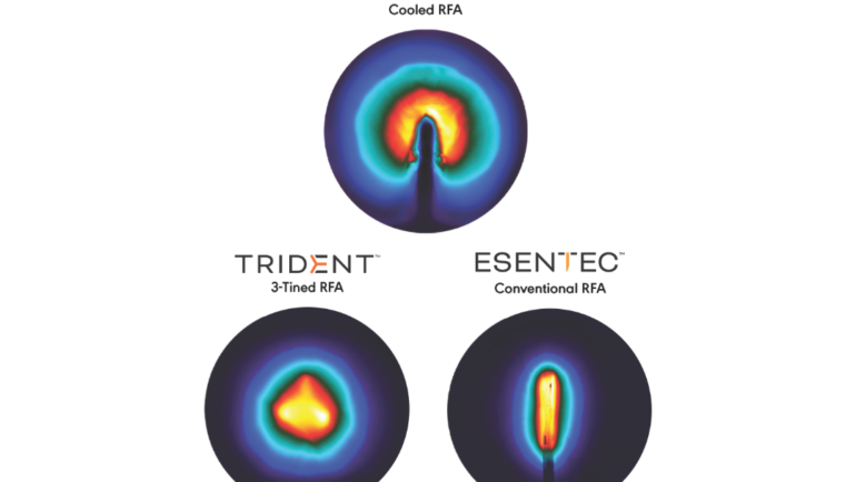 Coolief® Gekühlte RF-Therapie